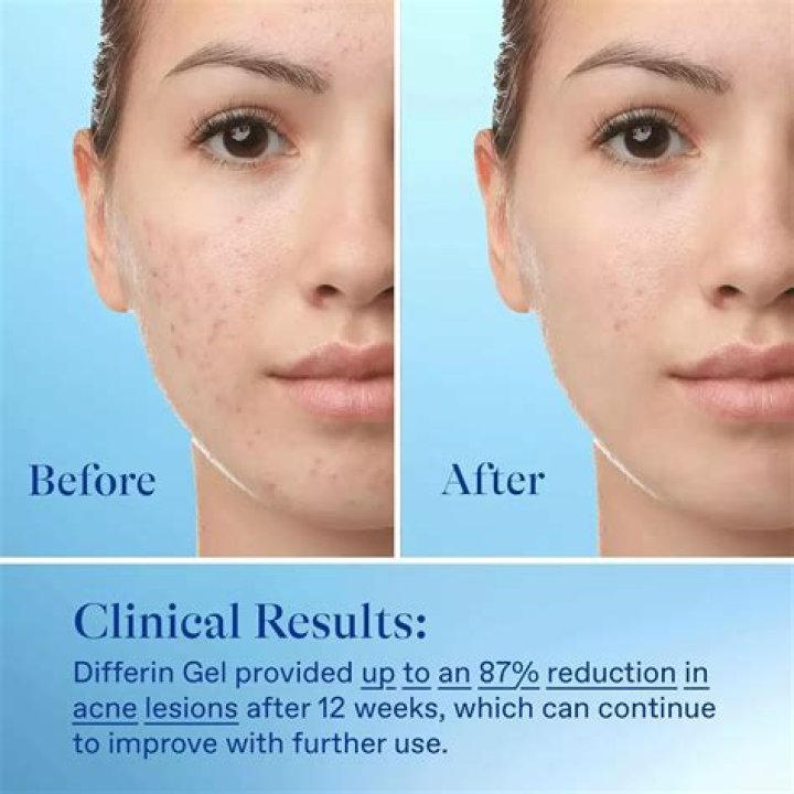 Differin Before and After: Transformative Results for Clearer Skin